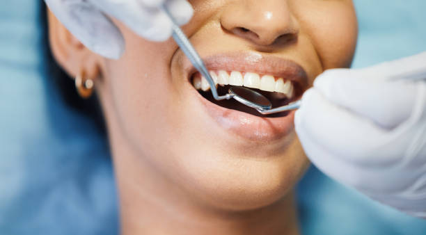 Best Chipped Tooth Repair Near Me  in Aberdeen, OH
